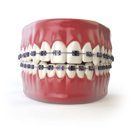 Ortodonti (Tel Tedavisi - Invisalign)